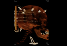 Under the Helmet: The Truth About Concussions